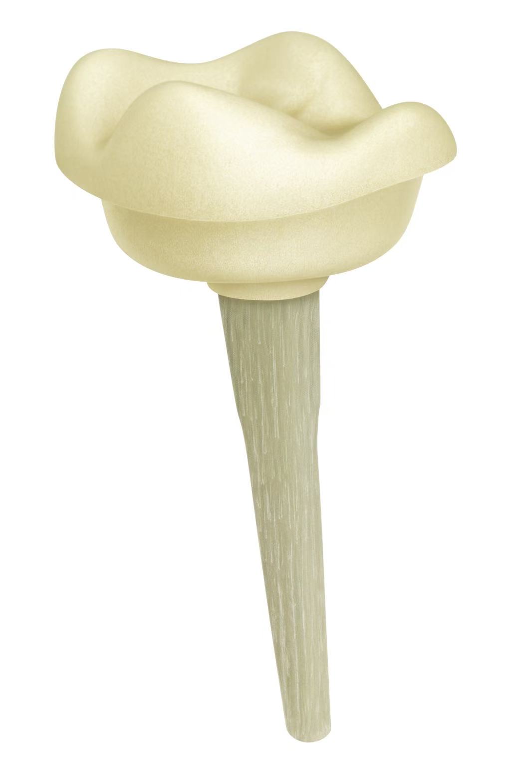 Inlay-core fibré Inlay-core fibré